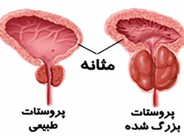 بزرگی پروستات